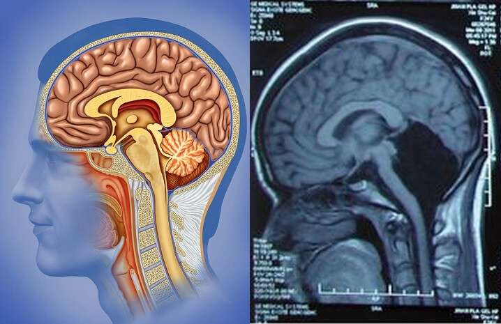 missing-cerebellum2