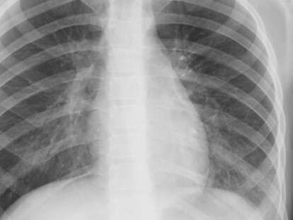 pnevmonia_1486647880