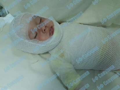 2-летний Русланчик перевернул на себя литровую кружку кипятка: малышу срочно нужна помощь (Видео)