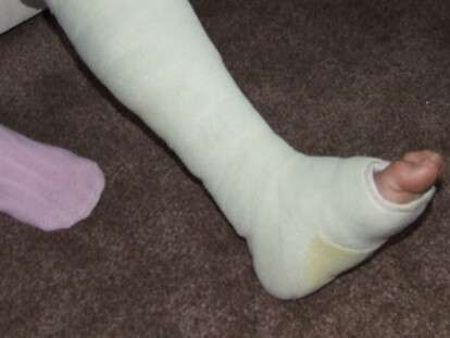 нога сломаная