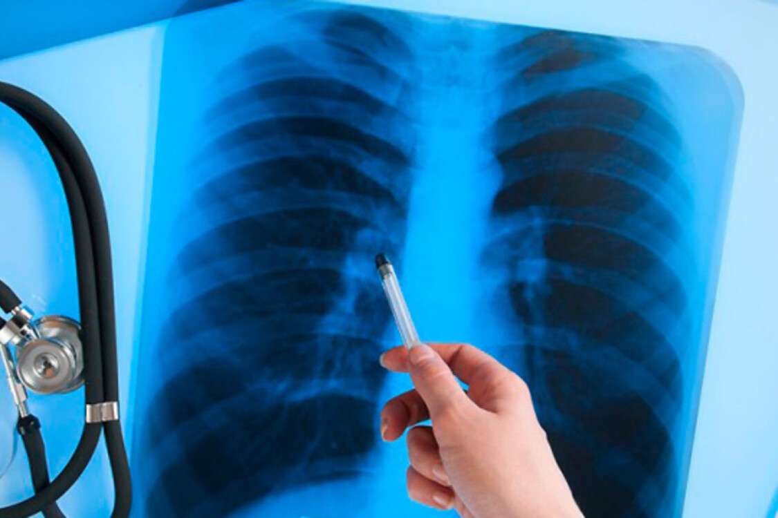 Туберкулез рентген
